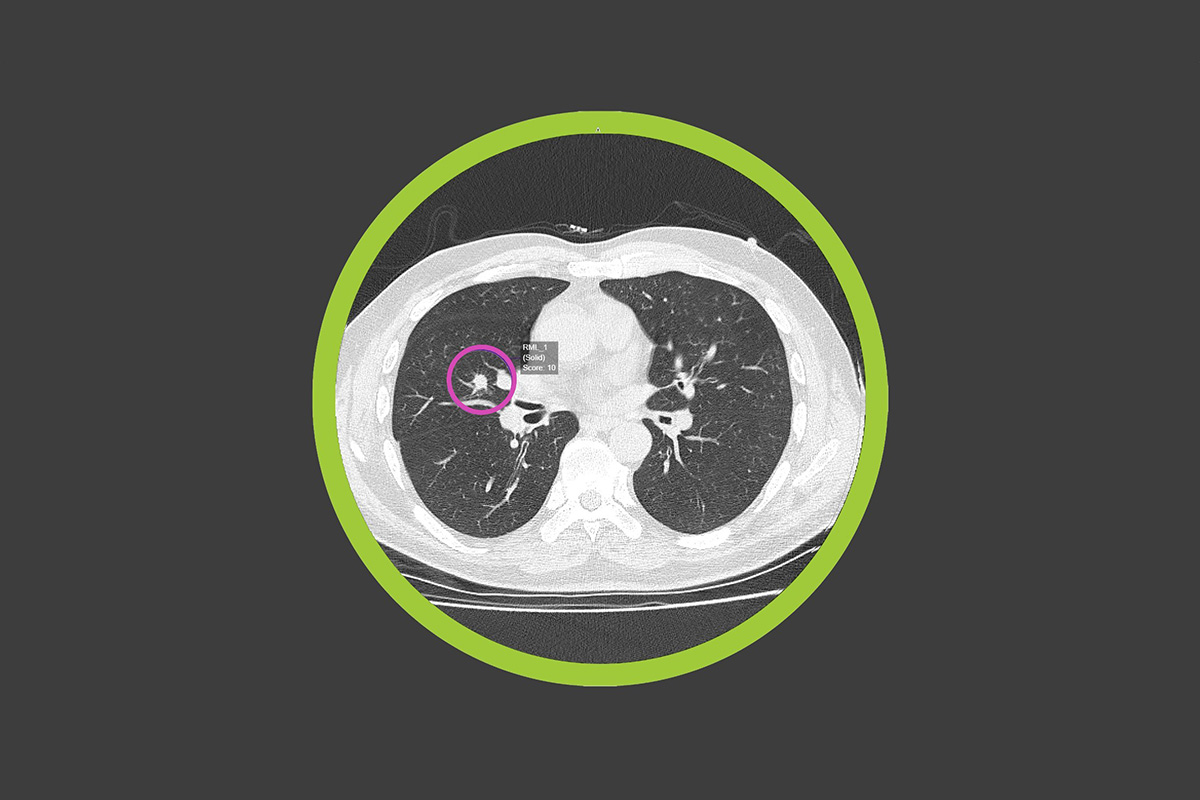 optellum-announces-strategic-collaboration-with-the-lung-cancer-initiative-at-johnson-&-johnson,-applying-ai-to-transform-early-lung-cancer-treatment